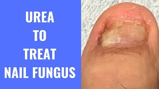 Use Urea To Treat Nail Fungus [upl. by Uriiah]