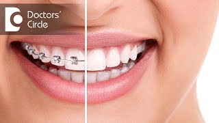 What happens to teeth after the braces are removed  Dr Divyashree Rajendra  Doctors Circle [upl. by Kirsten]