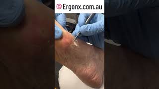 Callus removal in podiatry clinic by cutting debriding with a scalpel [upl. by Emilio451]