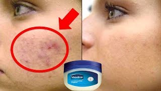 कैसे Vaseline से 3 दिन में चेहरे से दाग धब्बे मुँहासे के निशान झाइयों को गायब करें Vaseline Hacks [upl. by Silver]