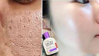 How to use Lacto Calamine Lotion  Lacto Calamine Lotion For Clear Spotless Brighten Skin [upl. by Luhem80]