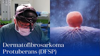 “Dermatofibrosarkoma Protuberans DFSP”  UzmDrDilqəm Məmmədov [upl. by Solomon]