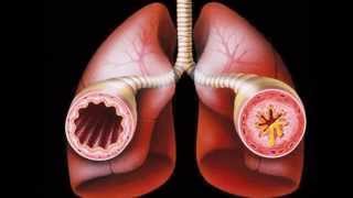 corticosteroids for asthma [upl. by Suoicserp]