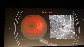 OCT Angiographie des neuropathies optiques  Dr MB Rougier  SFO2019 [upl. by Atsylac428]