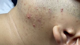 ACNE TREATMENT VU QUYNH MI Acne On Mans Chin 2024 [upl. by Richey]