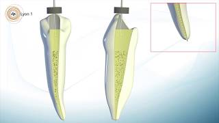 7 Obturation endodontique la technique de condensation latérale à froid Endodontie [upl. by Oliy]
