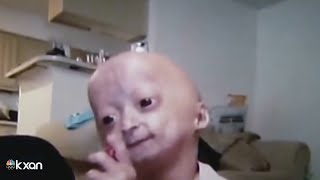 Adalia Rose Austinite social media star with rare genetic condition dies at 15 [upl. by Siekram]