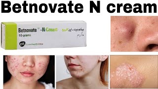 Betnovate n Skin care Cream How to use Benefits amp Side effects [upl. by Aer]