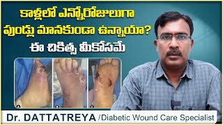 కాళ్లలో పుండ్లు మానట్లేదా  How are Chronic Wounds Be Treated  Dr Dattatreya  Wound Care Hospitals [upl. by Sharleen]