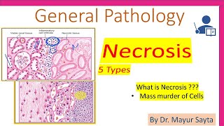 Necrosis  Pathology [upl. by Ttirb40]