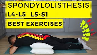 Spondylolisthesis treatment [upl. by Bambie989]