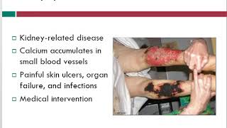 Calciphylaxis  Wound Care Topics  Free Wound Care Info  WoundEducatorscom [upl. by Ayotna]