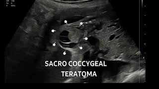 Sacrococcygeal teratoma at 22 weeksFollowup of this case httpsyoutubeYa59lnLs [upl. by Nniuqal]