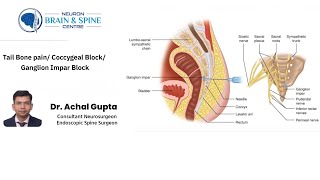 Tail bone pain Coccygeal block Ganglion Impar block  Dr Achal Gupta  Neuro amp Spine Surgeon [upl. by Buller704]