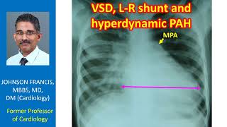 VSD LR shunt and hyperdynamic PAH [upl. by Auod]