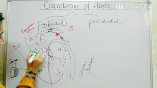 Coarctation of aorta congenital heart disease pediatric nursing  For gnm students [upl. by Ahselak]