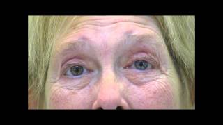 VIMPAT Blepharospasm Hemifacial Spasm Testimonial 2 [upl. by Animrelliug]