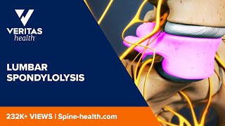 Lumbar Spondylolysis [upl. by Dorsman]