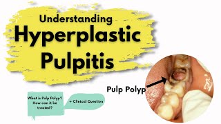 Pulp Polyp Hyperplastic Pulpitis  What is it  Diagnosis Treatment  Endodontics [upl. by Dan]