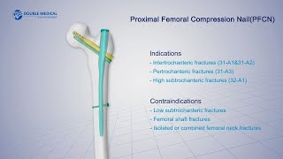 Double Medical Proximal Femoral Compression Nail  PFCN [upl. by Sigvard291]