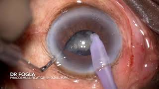 Phacoemulsification in an eye with non dilating small pupil [upl. by Amilb33]