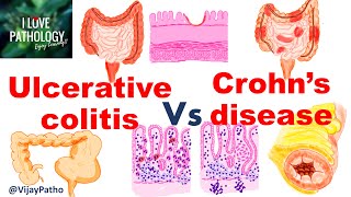 Ulcerative colitis Vs Crohns disease inflammatoryboweldisease [upl. by Iniretake]