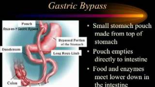 Introduction to Bariatric Surgery [upl. by Enomed]