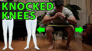 3 Power Exercises For Knocked Knees  Genu Valgus Flat Feet [upl. by Mala777]