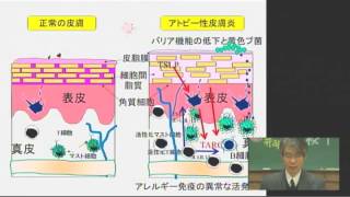 ①アトピー性皮膚炎の原因と悪化因子 [upl. by Ametaf692]