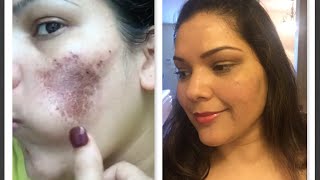 How to hidecover stubborn acne scarsbirth mark with makeup Power of makeup [upl. by Jillene]