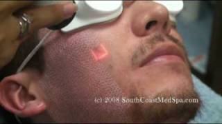 Active FX Laser Acne Scars Removal [upl. by Elad]