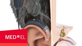 How Do Cochlear Implants Work  MEDEL [upl. by Solram]