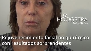 Rejuvenecimiento facial no quirúrgico con Láser de Co2 y Plasma Rico 15032 [upl. by Myrtice987]