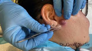 Drainage of an infected cyst in front of the ear [upl. by Nadabas188]