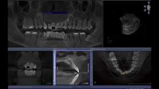 Nasopalatine Duct Cyst  Cone beam computed tomography [upl. by Cnut]