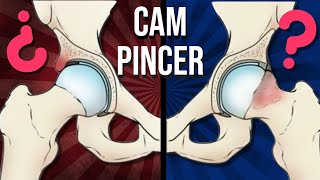 Cadera CAM y PINCER ¿qué son y por que se producen [upl. by Jasik]