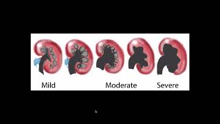 Hydronephrosis  Ultrasound [upl. by Namzaj334]