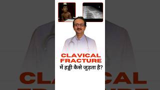 Clavical Fracture  Clavical Fracture में हड्डी कैसी जुड़ती है ।  Collar Bone Fracture in Children [upl. by Pretrice655]