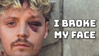 I Broke My Face LIVE Storytime [upl. by Dragde]