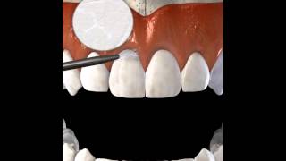 Restauración cervical Clase V [upl. by Darej]