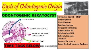 Odontogenic Keratocyst HISTOPATHOLOGY TREATMENT  Causes of recurrence DETAILED part 2 Time tag [upl. by Hinman]