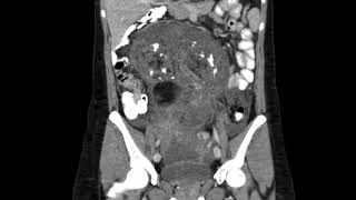 Ovarian Teratoma Coronal CT [upl. by Walker]