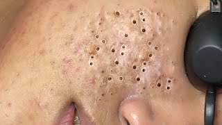 Super squeeze acne asmr Relaxing 39 [upl. by Sidnee990]