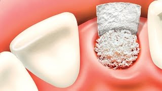 Bone grafting procedure [upl. by Lamej]