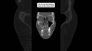 Neuronavigation and Endoscopy as Adjunctive Tools in Orbital Floor Implant Revision surgery [upl. by Rhody]