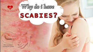 Scabies mites coming out of my skin [upl. by Enelra]