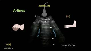 Introduction to lung ultrasound for the nephrologist I Dr Koratala NephroP [upl. by Leahkim]