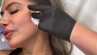 FILL ACNE SCARS PERMANENTLY WITH BELLAFILL FILLER INJECTIONS  West Hollywood CA  Dr Jason Emer [upl. by Neelear]