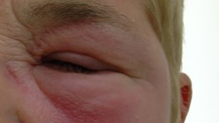 Treatment of gross eye swelling following an insect bite [upl. by Nosdrahcir868]