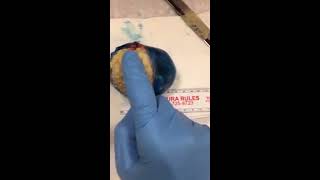 CUTTING INTO A DERMOID CYST teratoma OVARY CAUTION [upl. by Ahseim66]